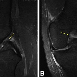 (A) Sagittal T2-weighted magnetic resonance imaging (MRI) of the left ...