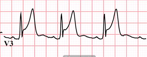 Dr. Smith's ECG Blog: A 30 year old with Chest Pain, Anterior ST Elevation, Terminal QRS ...