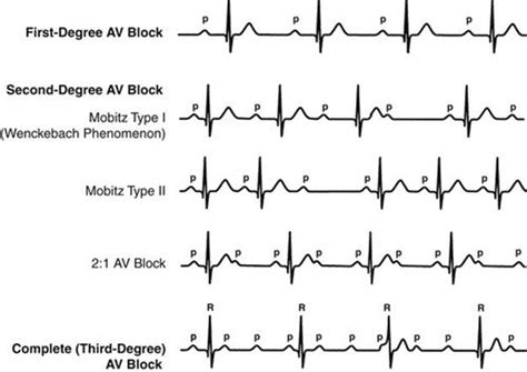 Second-Degree Heart Block: Symptoms, Causes, Treatment,, 45% OFF