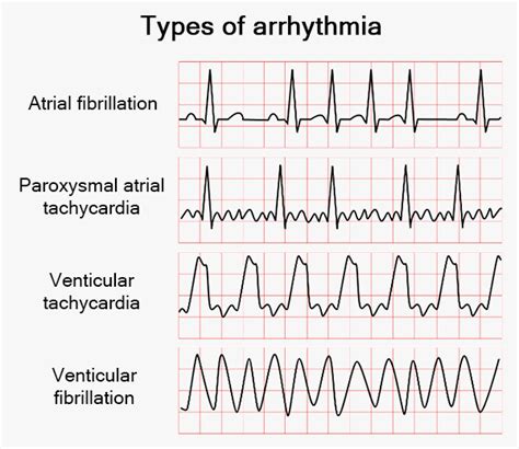 What Are The Three Different Types Of Arrhythmia - Printable Templates ...