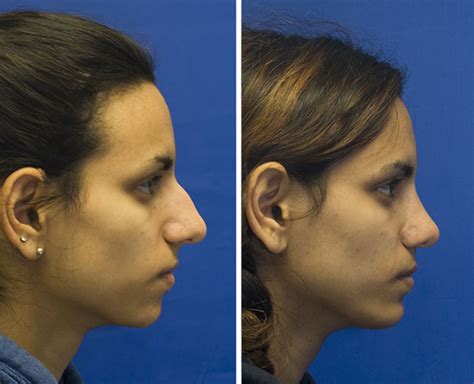 Indian/Pakistani Rhinoplasty | Rhinoplasty in Seattle | Rhinoplasty Surgeon