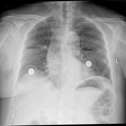 Lung Air Fluid Level