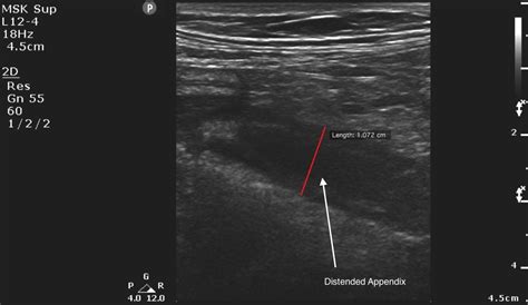 Appendicitis | Emory School of Medicine