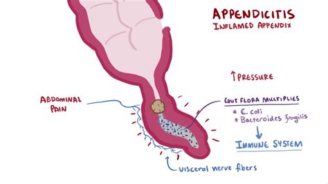 Appendicitis - Wikipedia