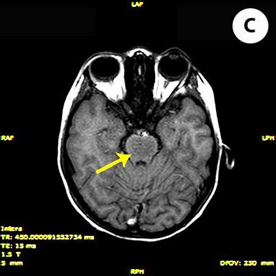 Axial T1-weighted image showing pontine lesion with low signal... | Download Scientific Diagram