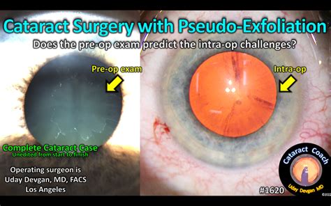 1620: pseudo-exfoliation cataract surgery – Cataract Coach