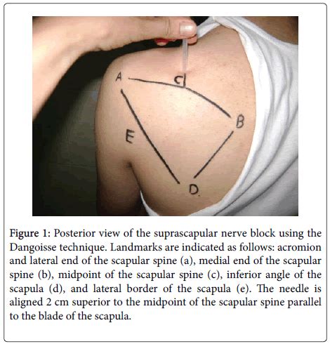 lupus-suprascapular-nerve-block