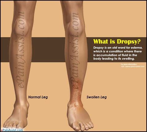 Pin on Vascular Disease