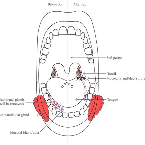 Operations on 16 children with severe sialorrhea treated surgically. | Download Table