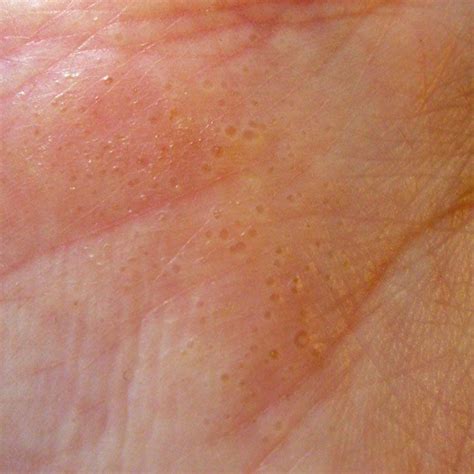 Hand Eczema or Dyshidrosis. This is a picture of my hand when I have a flare-up. It comes up as ...