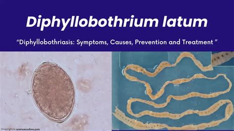 Diphyllobothriasis and Diphyllobothrium latum 2024; Diagnosis, Symptoms ...