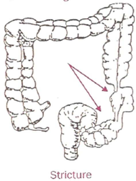 IRIDOLOGY: ANW, Stricture of Colon