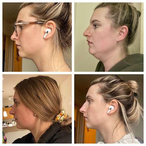 Kybella: 5 weeks post 1 round injections (2vials). TL: pre treatment, TR: most swelling (5 hours ...