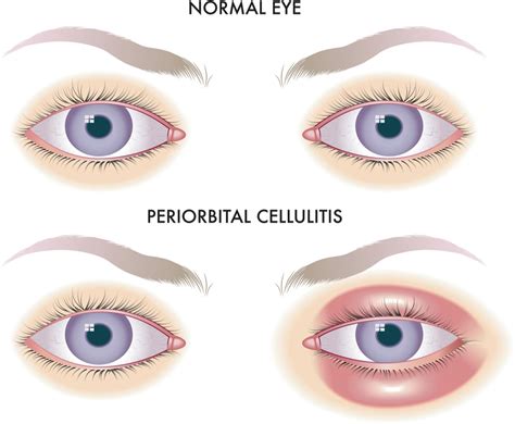 Periorbital Cellulitis | MyVision.org