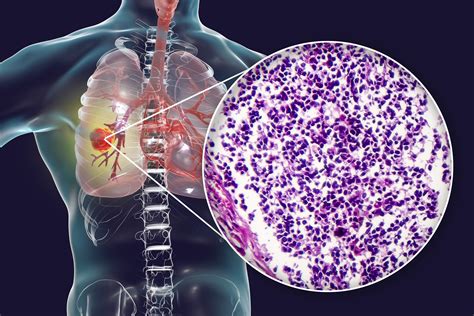 Imfinzi May Contribute to Long-Term Survival Improvements in Unresectable Non-Small Cell Lung Cancer