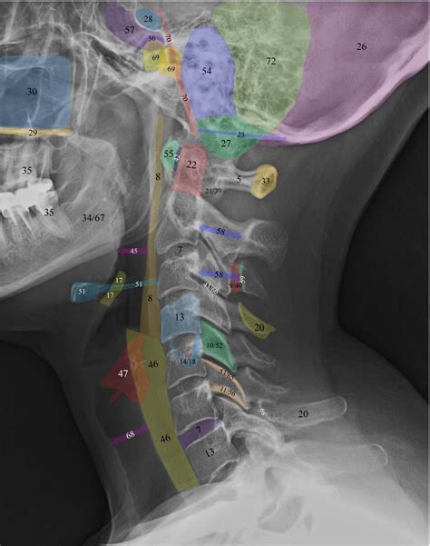 Normal Radiographic Anatomy of the Cervical Spine | Anatomy, Radiology ...