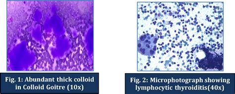 Figure 2 from A CORRELATIVE STUDY OF FNAC THYROID WITH THYROID HORMONE ...