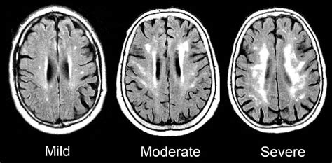 Cerebral Small Vessel Disease: What to Know & What to Do