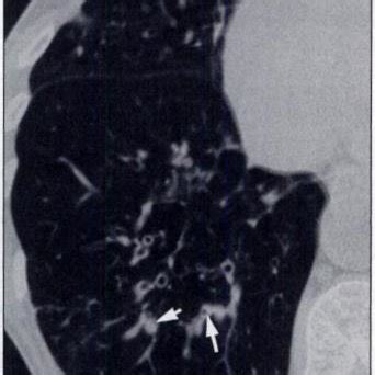 -54-year-old man with varicose bronchiectasis and air trapping. CT scan... | Download Scientific ...