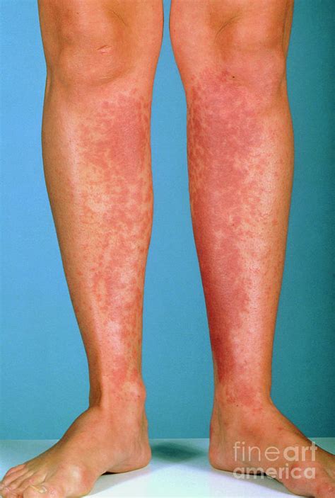 Contact Dermatitis To Shins Due To Shaving Foam Photograph by St ...