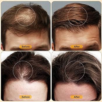 Az igazsághoz menő megszelídít microneedling hair minoxidil vonatkozás ...