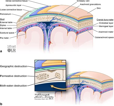 Radiological review of skull lesions | Insights into Imaging | Full Text