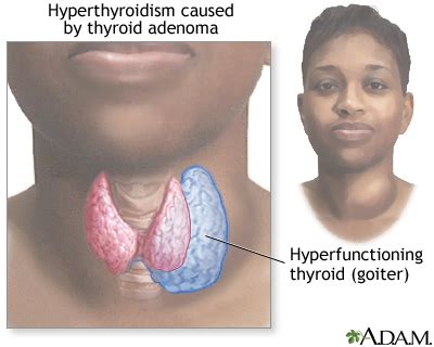 Goiter: MedlinePlus Medical Encyclopedia Image