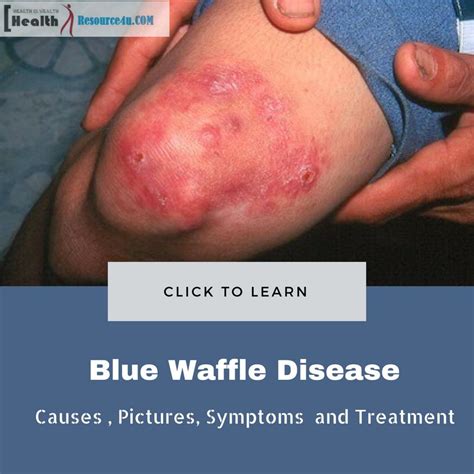 Pin on Blue waffle disease