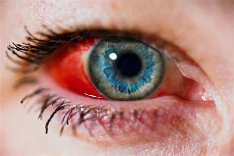 60+ Subconjunctival Hemorrhage Stock Photos, Pictures & Royalty-Free ...