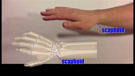 Anatomical Snuffbox scaphoid fracture navicular orthopedic surgery orthopaedic orthopaedics ...