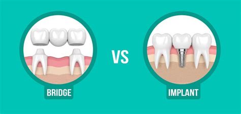 Missing a tooth? Dental Implant versus Dental Bridge: Which treatment is best for you ...