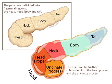 Pancreatic uncinate process - Ronny Allan - Living with Neuroendocrine ...