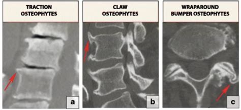 What Is Osteophytic Lipping In The Hip | Sitelip.org