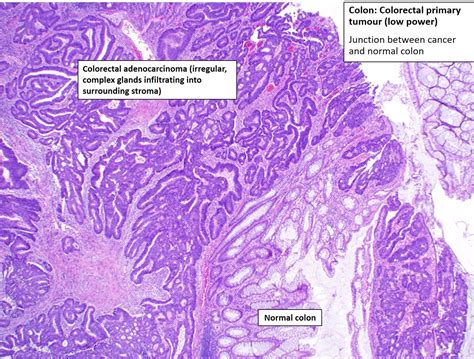 Liver – Metastatic Carcinoma – NUS Pathweb :: NUS Pathweb