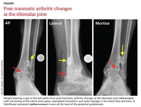 Tibiotalar Joint Osteoarthritis | My XXX Hot Girl