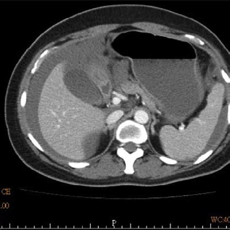 Computerized tomography. Massive amount of intraperitoneal fluid... | Download Scientific Diagram