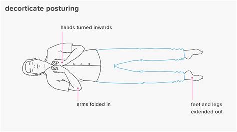 Decorticate Posturing: Symptoms and Causes