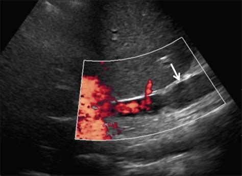 68-year-old man three months status post liver transplant with IVC clot... | Download Scientific ...