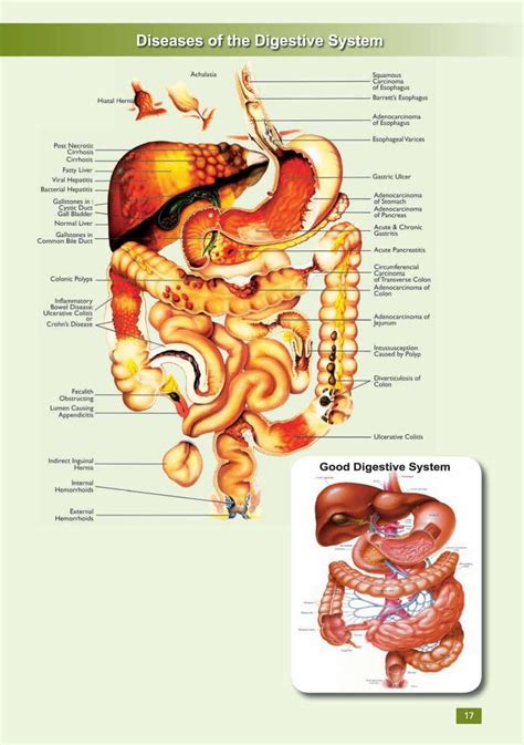 digestive system disease | Digestive system, Human digestive system ...