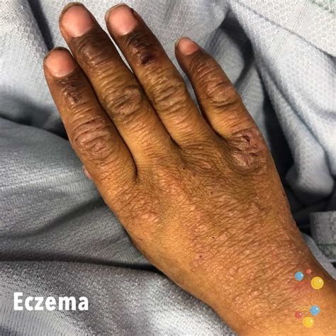 Eczema - Skin Deep