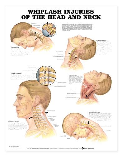 Whiplash Chart - Whiplash Injuries of the Head and Neck