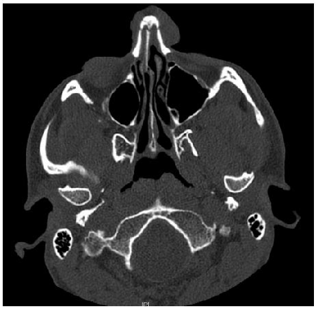 The CT scan axial views on admission showing a comminuted nasal ...