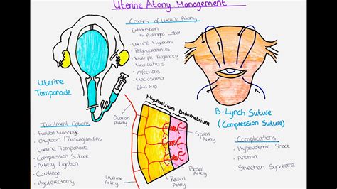 Understanding Uterine Atony and Ways to Treat it (Postpartum ...