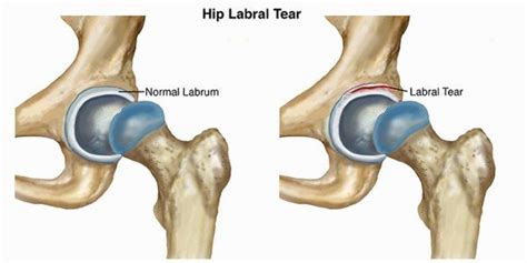 Hip Labral Tear (FAI) - Is It Surgery Worthy?