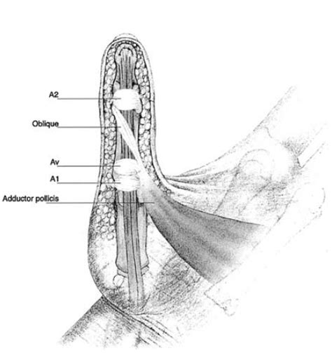 Finger Pulleys - Patterns of Pathology | All-American Teleradiology