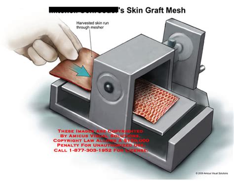 AMICUS Illustration of amicus,surgery,skin,graft,mesh,harvested,mesher