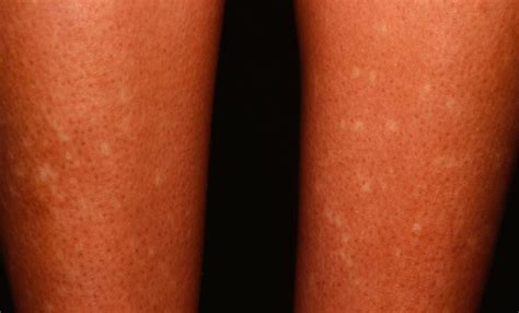 White Spots on Legs Causes and Fast Home Remedies - Skincarederm