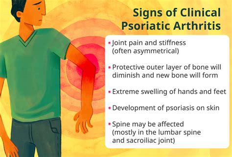 Different Types Of Psoriatic Arthritis: Symptoms,, 49% OFF