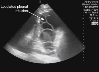 Ultrasound Artifacts | Radiology Key