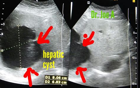 Ultrasound imaging: Simple-hepatic-cyst